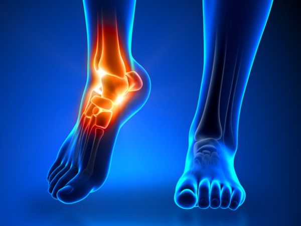 Posterior Tibial Tendon Dysfunction (PTTD) Podiatry Treatment Redhill